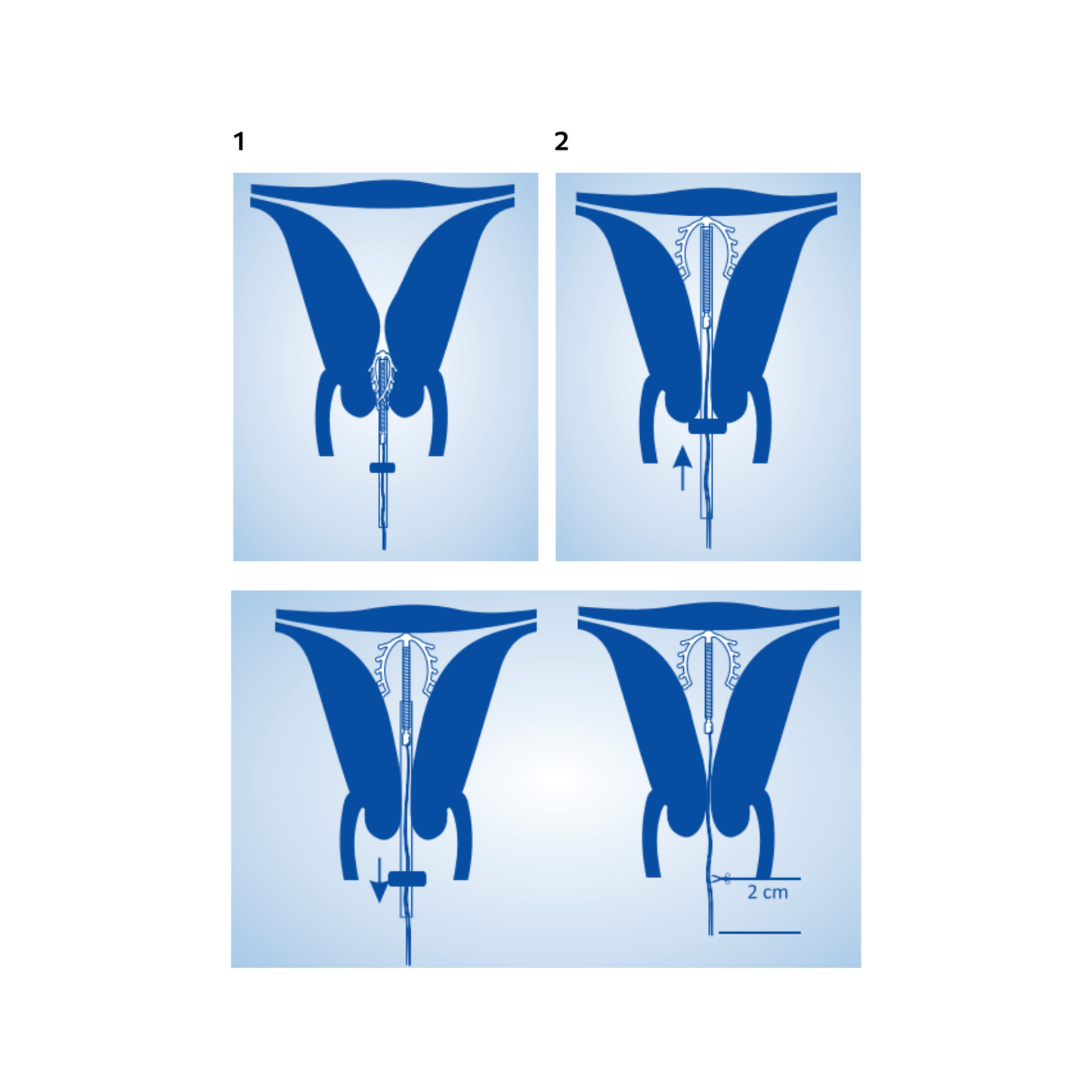 Spirale Anticoncezionale Intrauterina Sterile IUD ad Ancora Cu 375